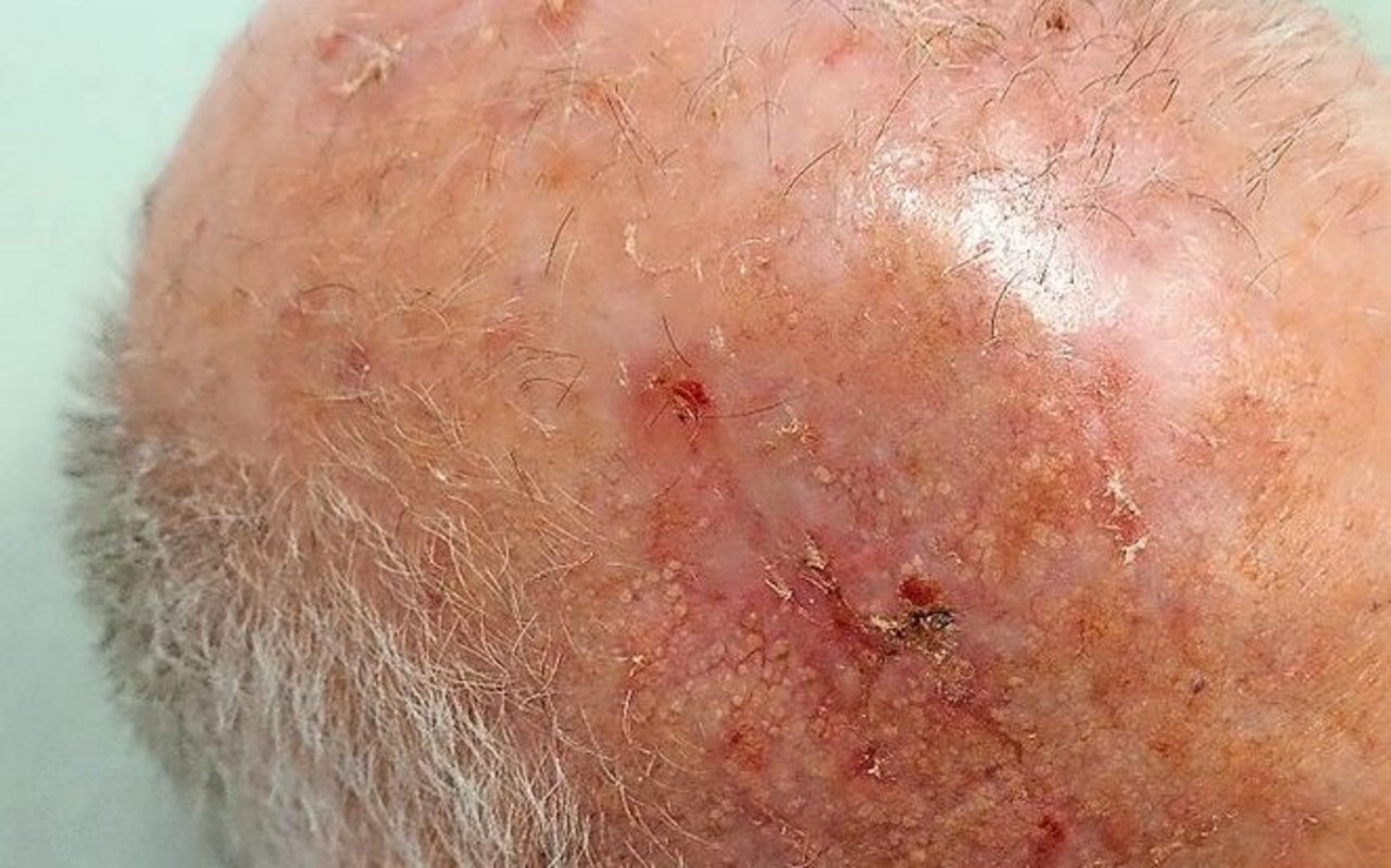 Krebsvorstufe: aktinische Keratosen auf einer Glatze.