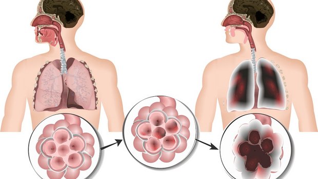 In den Lungenbläschen findet der Gas-Austausch statt. rechts eine gesunde Lunge, links eine Lunge mit COPD. Schädliche Partikel führen zu Entzündungen der Schleimhäute der Lungenbläschen. Rechts zu sehen: Die Membrane brechen zusammen. Bild: Fotolia