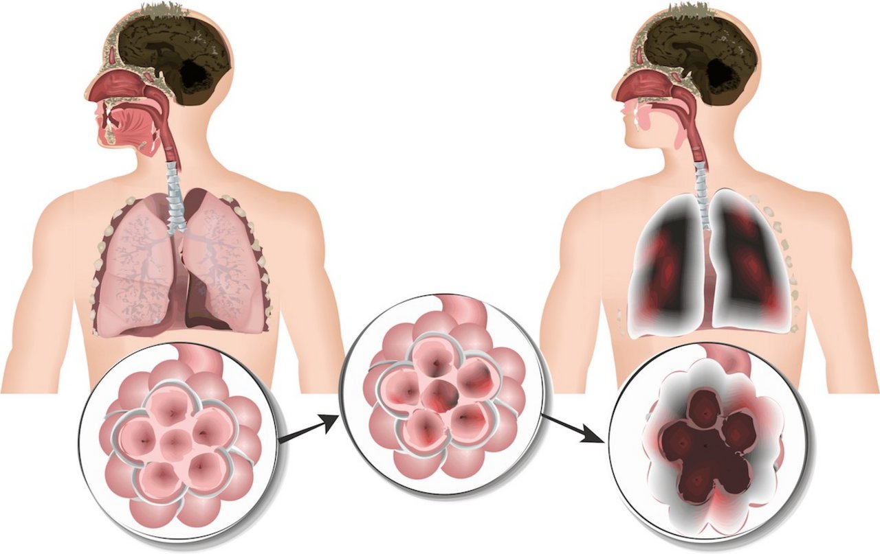 In den Lungenbläschen findet der Gas-Austausch statt. rechts eine gesunde Lunge, links eine Lunge mit COPD. Schädliche Partikel führen zu Entzündungen der Schleimhäute der Lungenbläschen. Rechts zu sehen: Die Membrane brechen zusammen. Bild: Fotolia