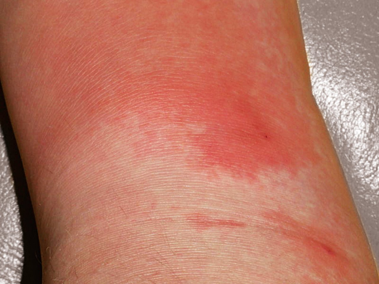 Menschen können an Rotlauf erkranken, den Hautrötungen fehlt jedoch das typische Aussehen. Bild: Suisag